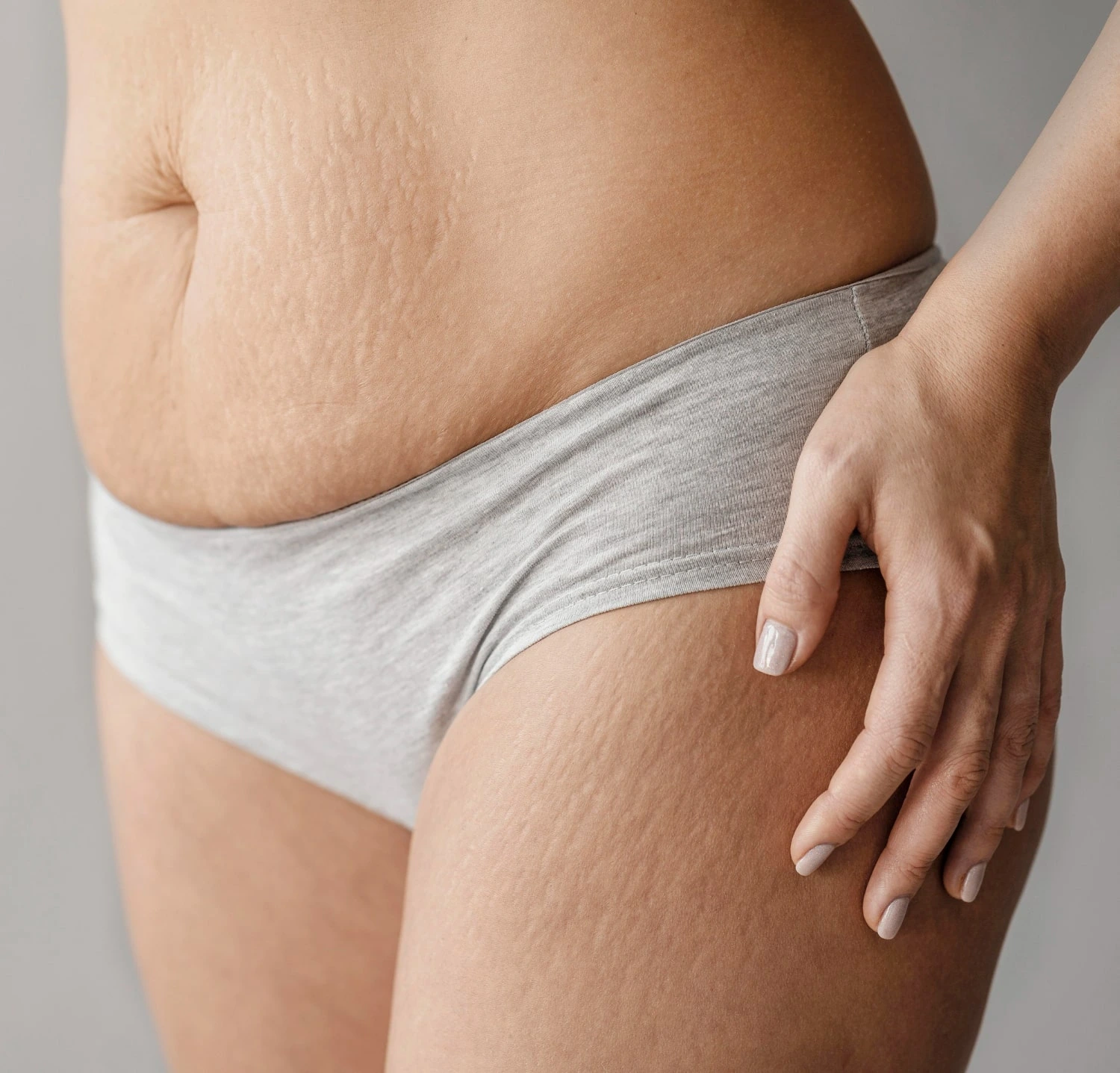 treating stretch marks with laser treatment removal