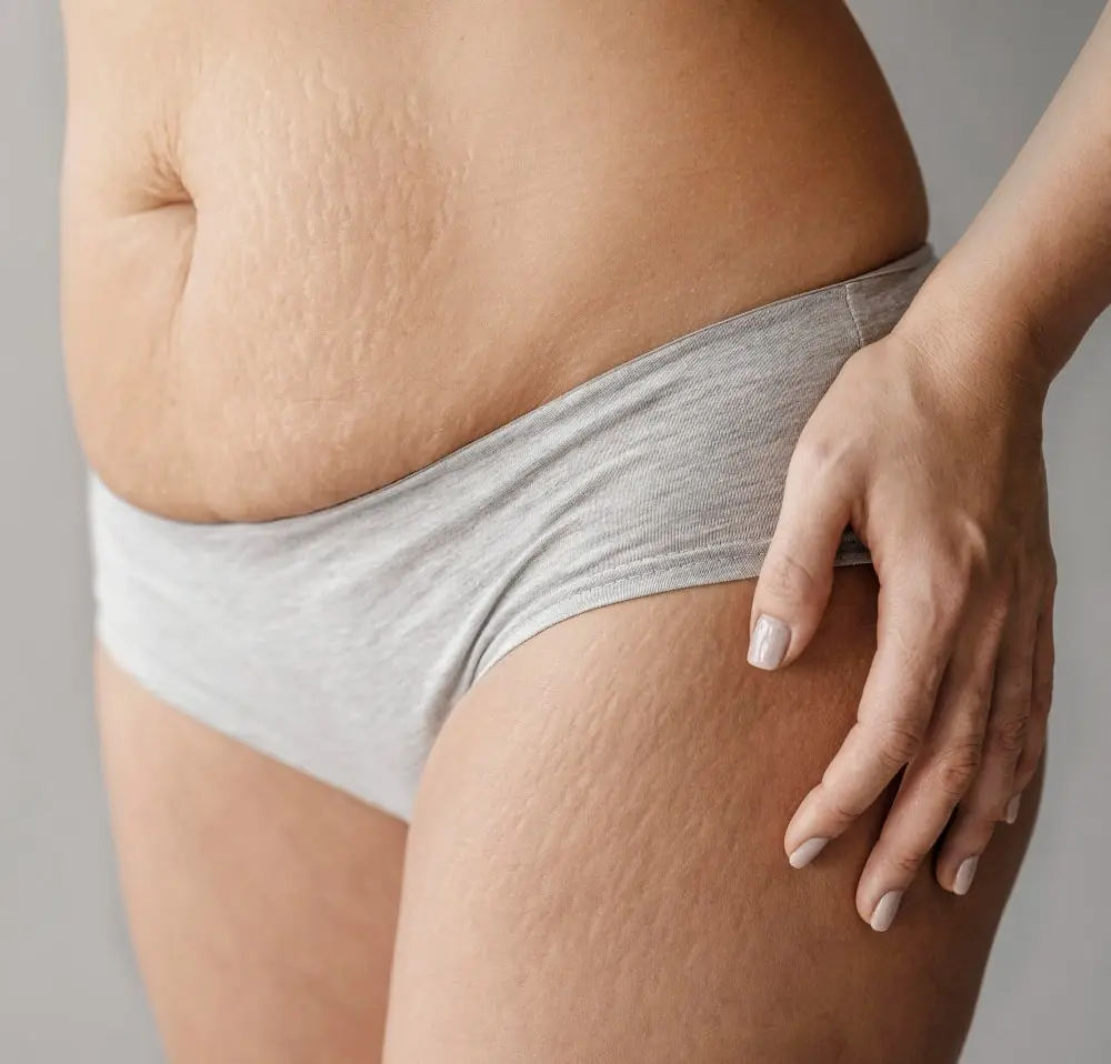 Close-up woman with stretch marks